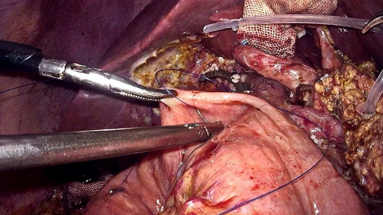 Reverse Needle Continuous Suture of the Pancreatic Duct to Jejunal Mucosal Pancreaticointestinal Anastomosis in Laparoscopic Pancreaticoduodenectomy