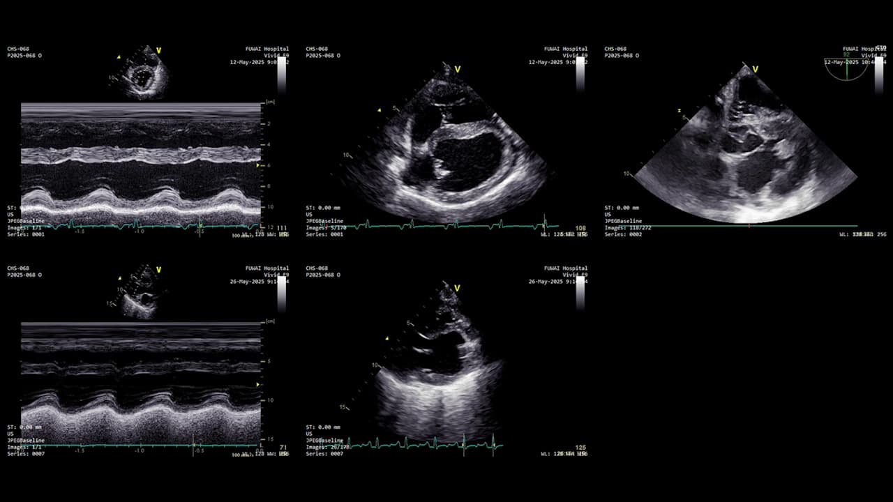 Implantation of Left Ventricular Assist Device (LVAD) in Juvenile Landrace Swine: A LVAD Implantation Model of Pediatric Heart Failure