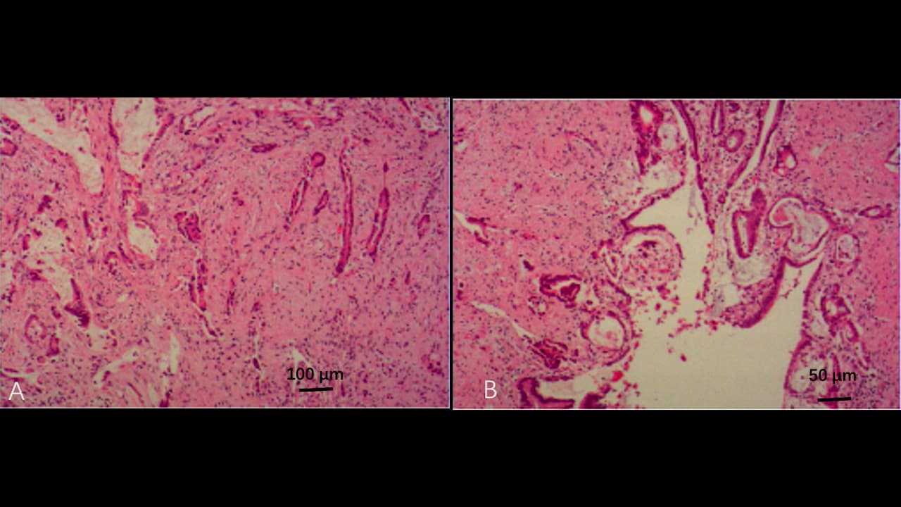 Intraoperative Strategy under Complex Vascular Adhesion for Laparoscopic Radical Resection of Bismuth-Corlette Type IIIb Perihilar Cholangiocarcinoma