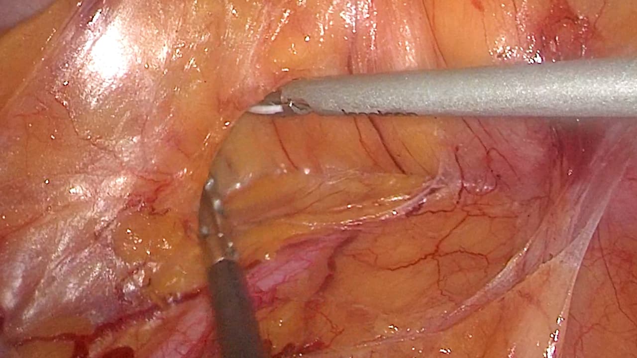Caudal-to-cranial Approach in Laparoscopic Right Hemicolectomy with Complete Mesocolon Excision and D3 Lymph Node Dissection