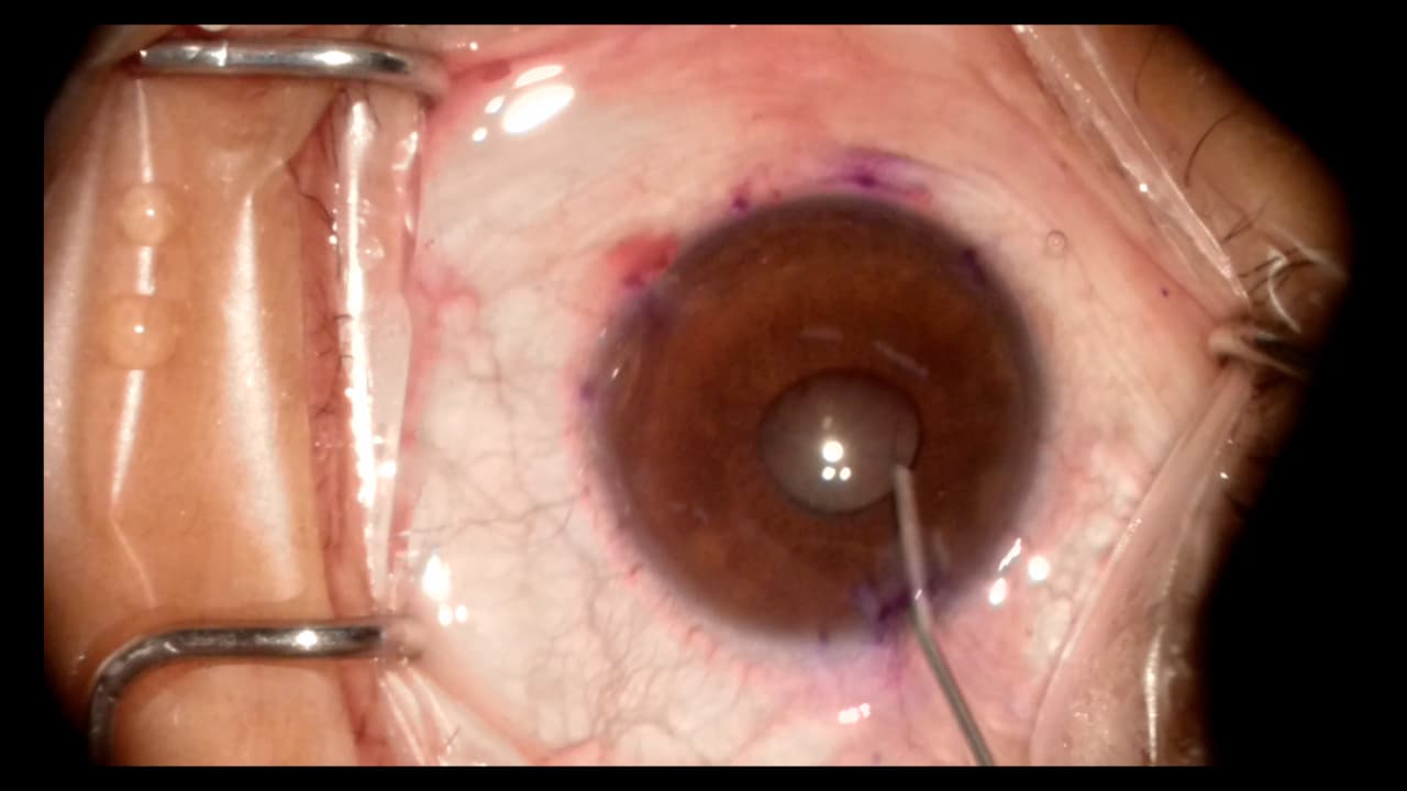 Trabeculotome Tunneling Trabeculoplasty (3T): A Step-by-Step Surgical Protocol for Primary Open-angle Glaucoma