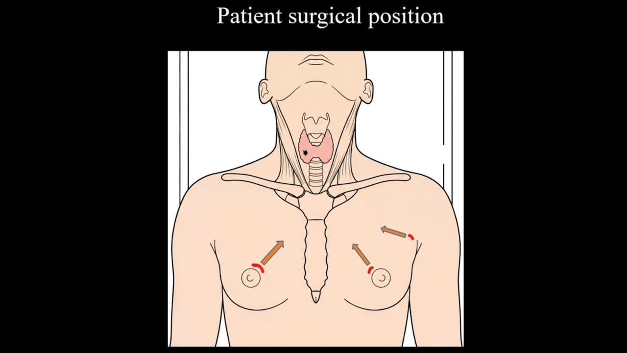 A Novel Contralateral Axillo-Bilateral-Breast Approach for Endoscopic Thyroid Surgery