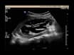 Laparoscopic Pyeloplasty via Transmesenteric Approach for Pediatric Ureteropelvic Junction Obstruction