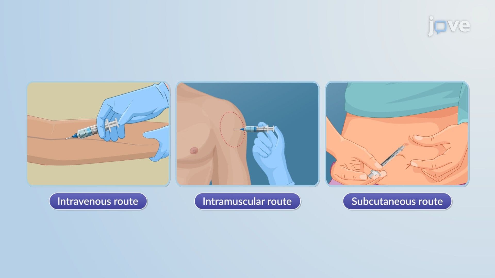 Parenteral Drug Delivery Systems: Injectables, Implants, and Infusion Devices