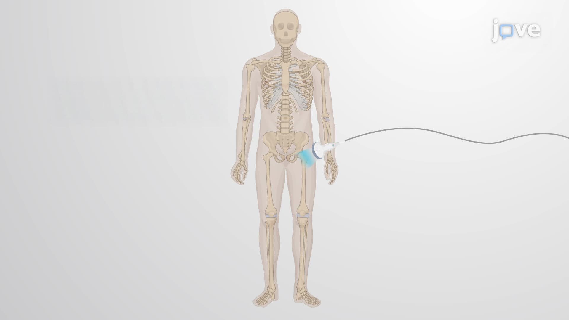 Assessing Bone Mineral Density Using Radiofrequency Echographic Multi-Spectrometry