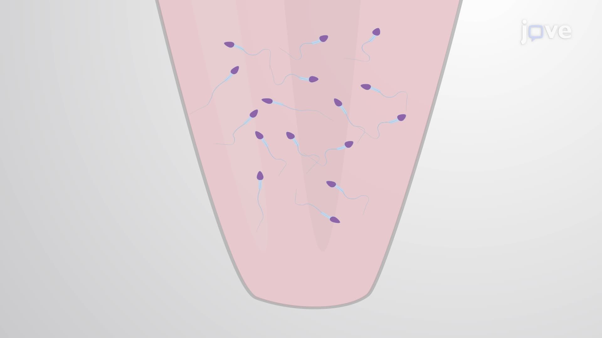 A Technique for Percutaneous Epididymal Spermatozoa Aspiration and Processing