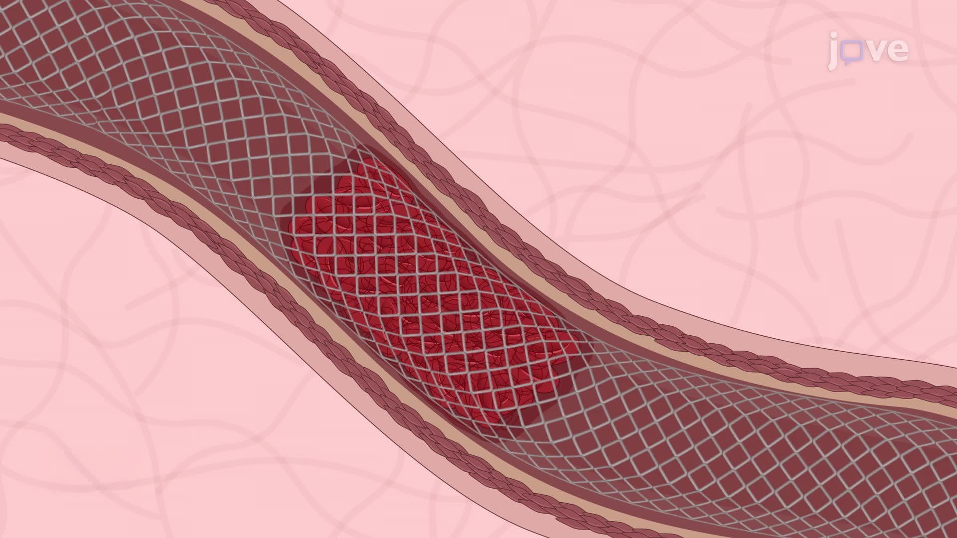 Endovascular Treatment of Acute Ischemic Stroke Using the Stent Retriever-Assisted Vacuum-Locked Extraction Technique