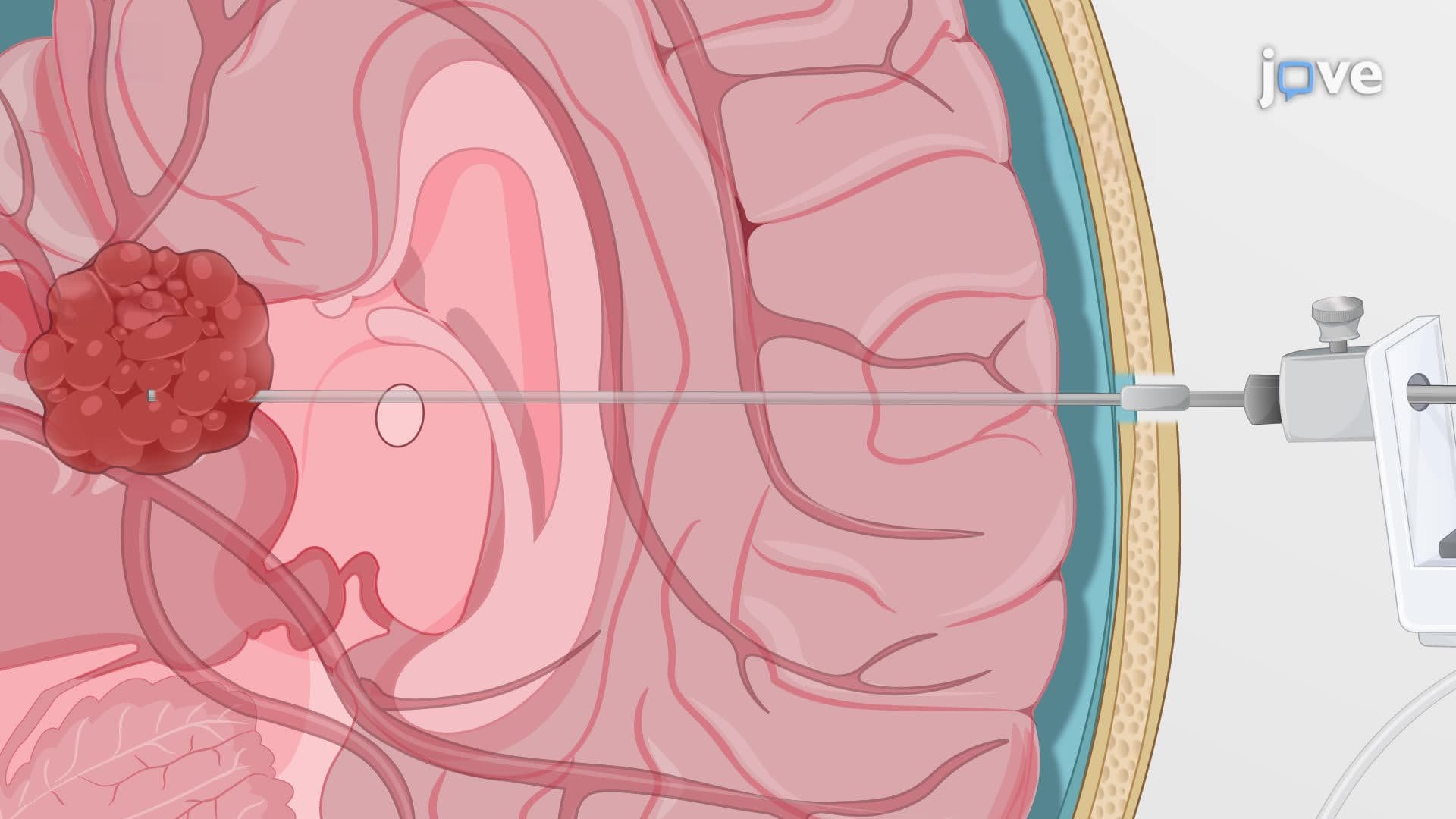 Laser Interstitial Thermal Therapy for Intracranial Tumor Ablation in a Human Patient