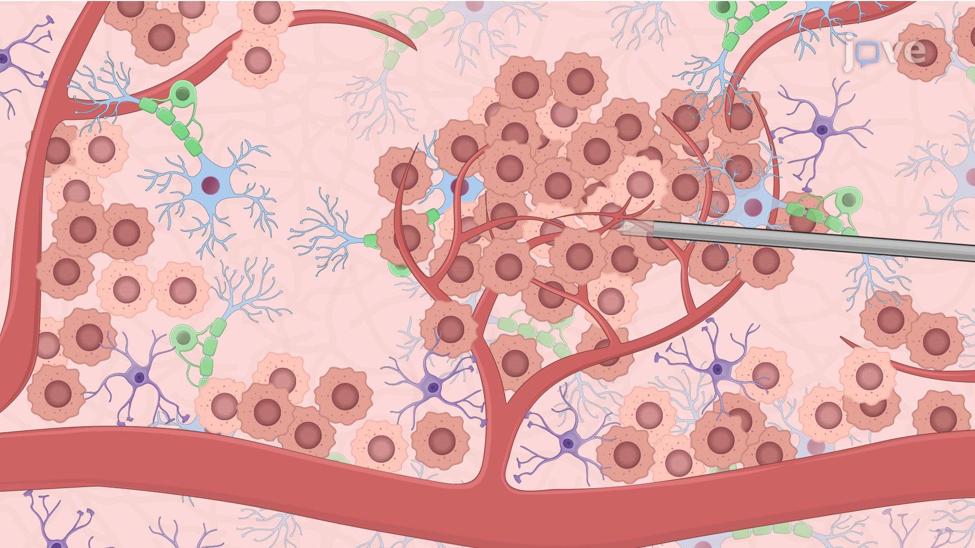 Enhancing Drug Delivery in Recurrent Glioblastoma with Laser-Induced Hyperthermia