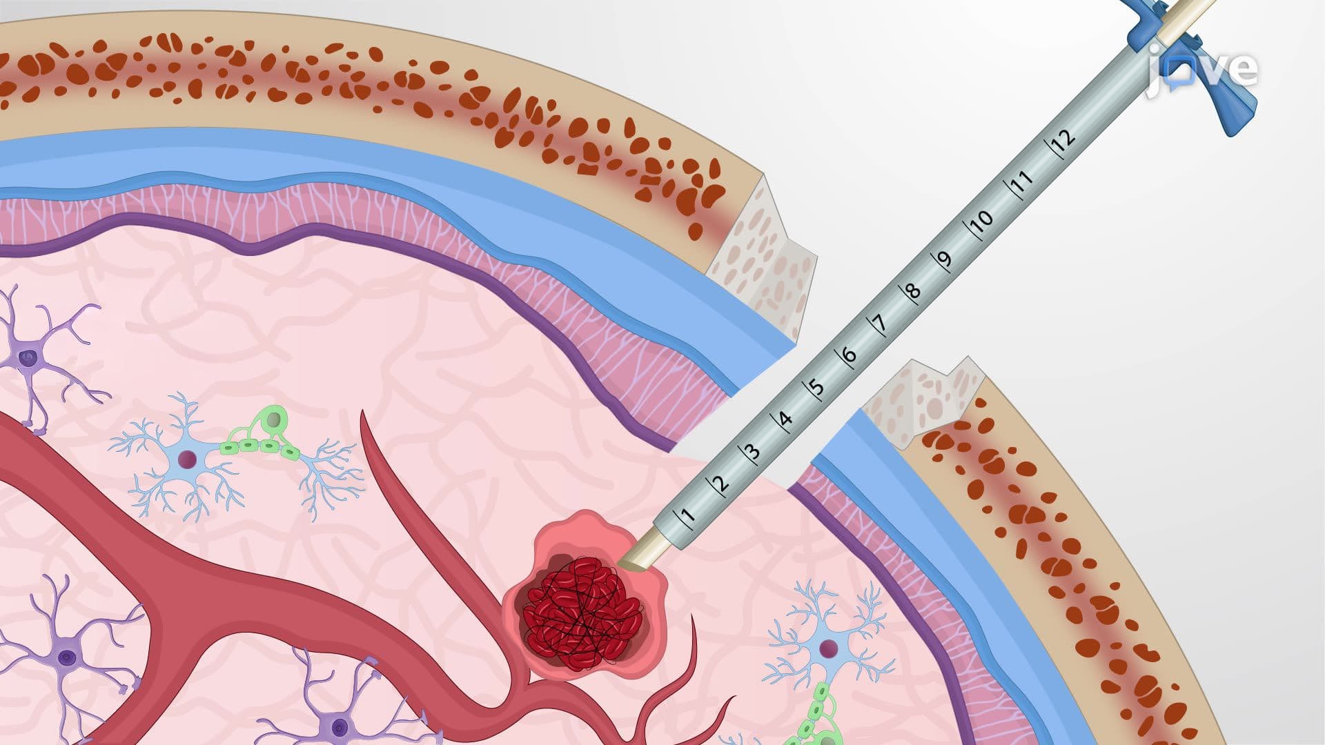 Minimally Invasive Endoscopic Procedure for Hematoma Removal from the Human Brain