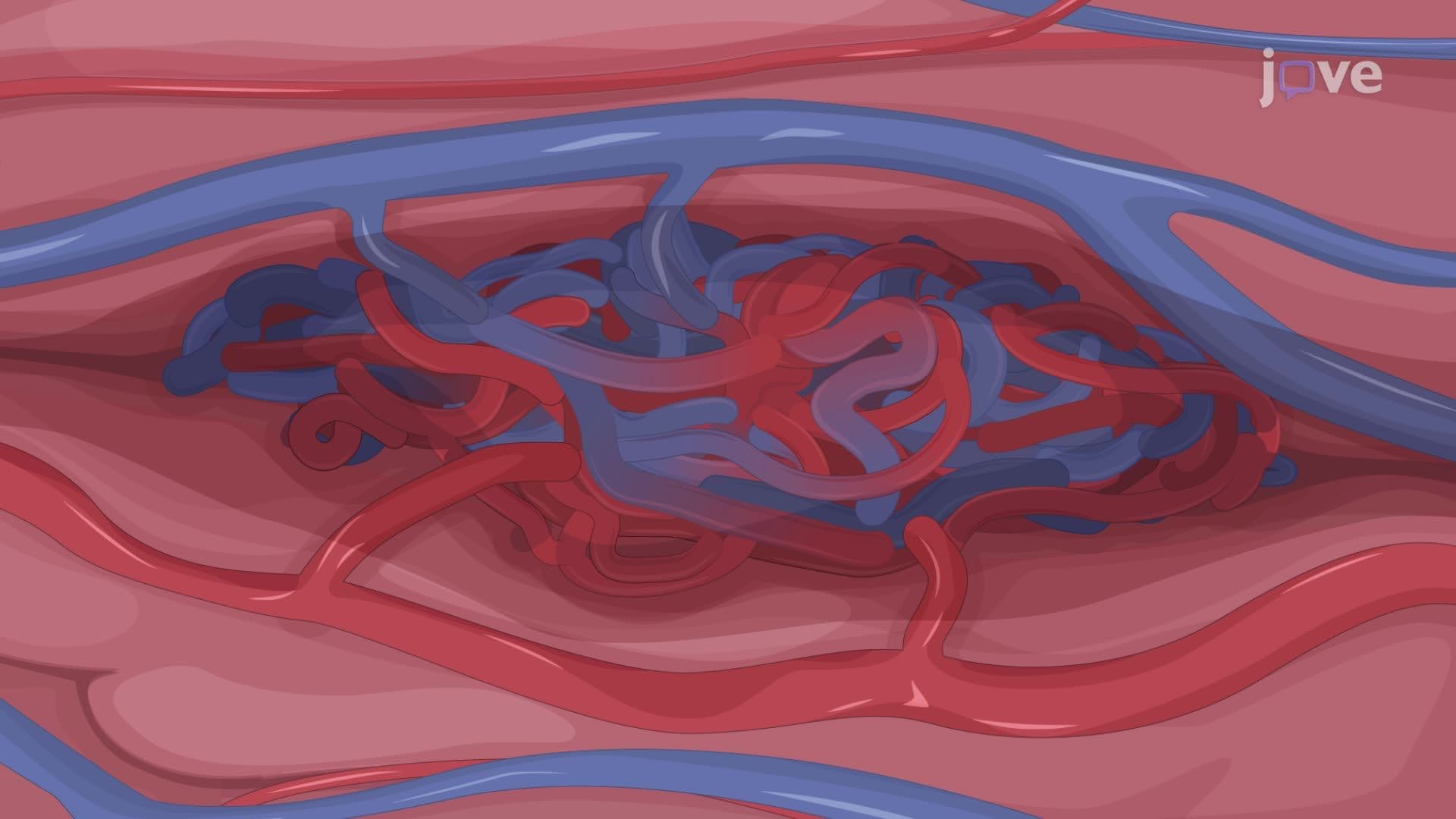 Open Surgical Resection of Cerebral Arteriovenous Malformations