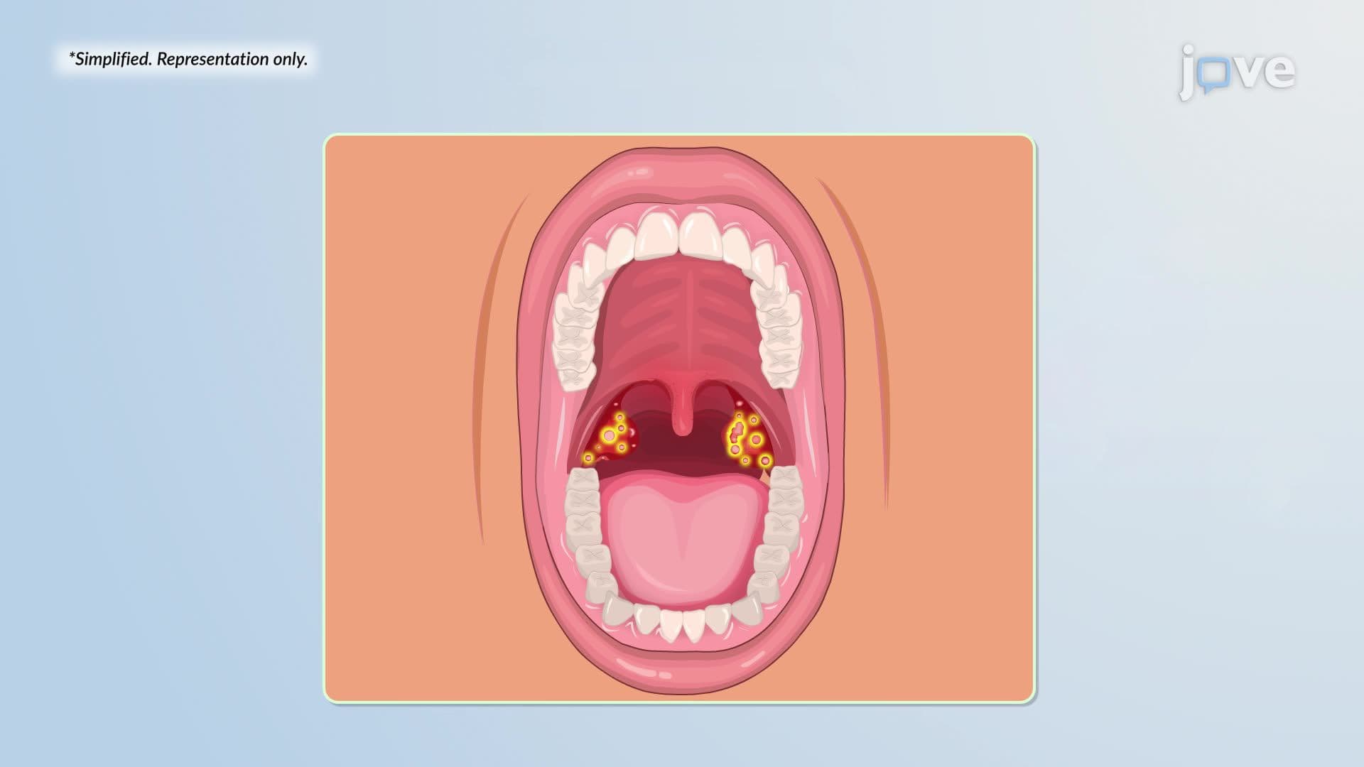 Streptococcal Pharyngitis
