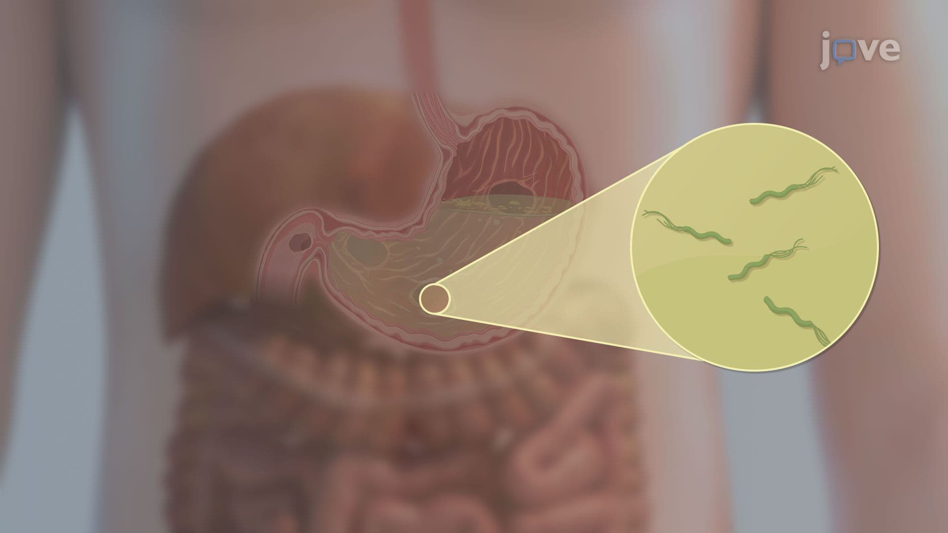 Peptic Ulcer