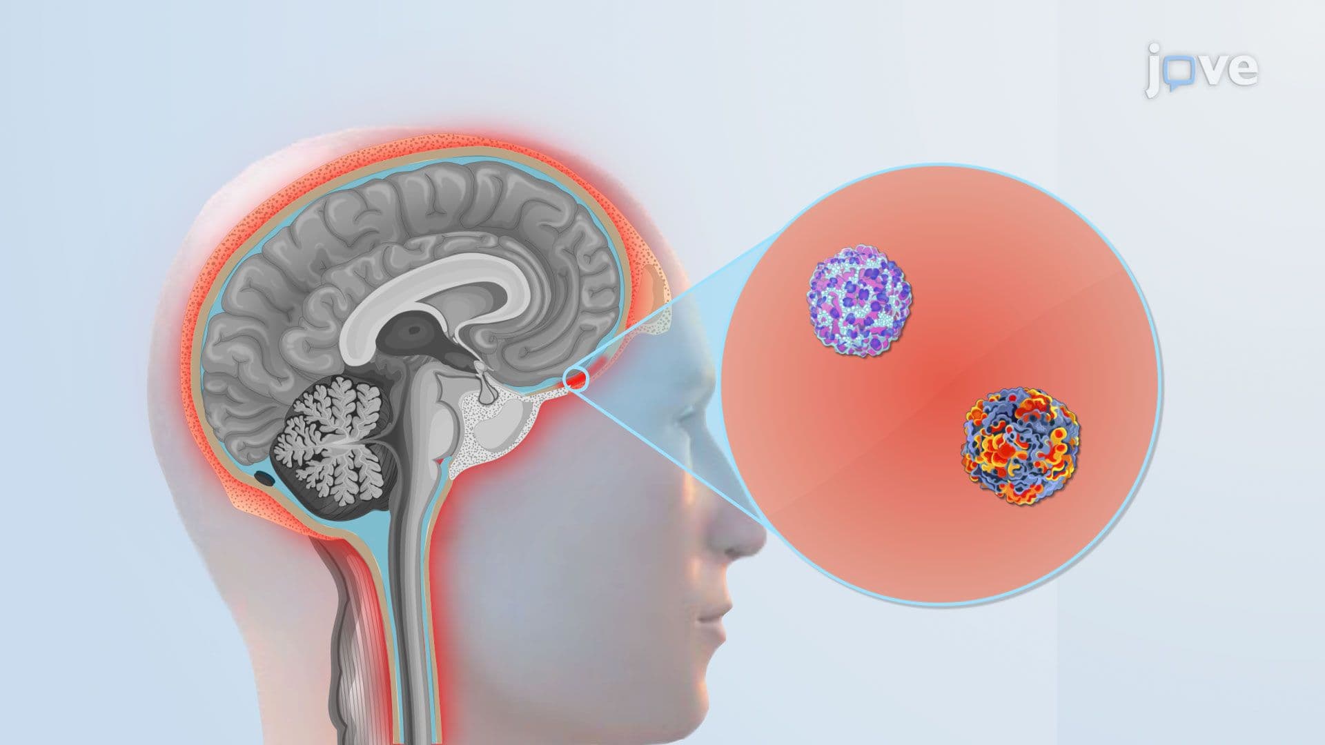 Viral Meningitis