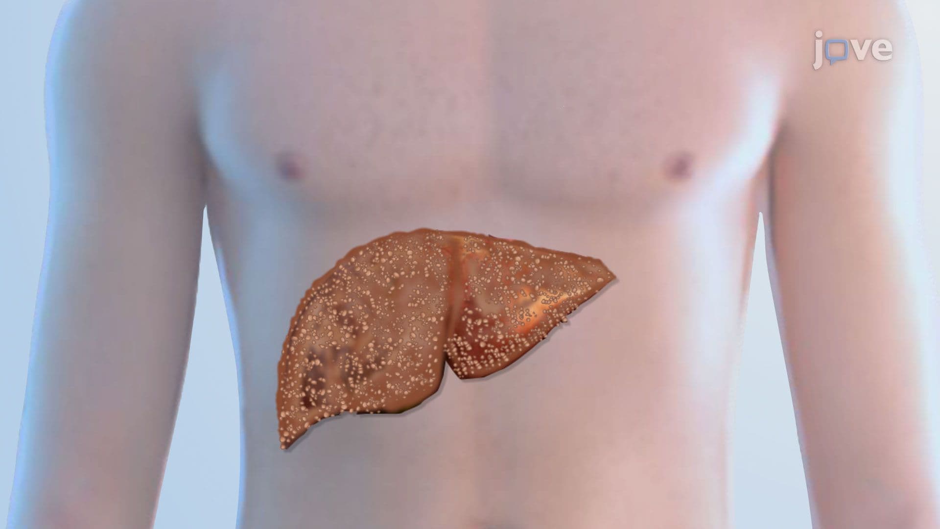 Hepatitis