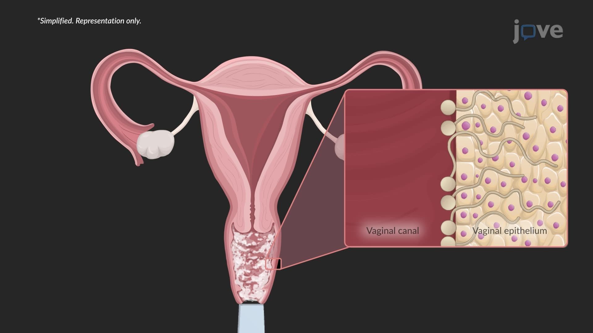 Candidiasis