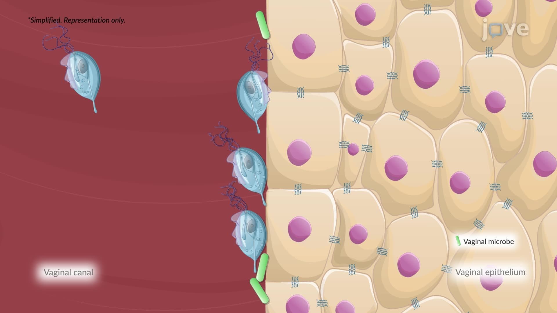 Trichomoniasis
