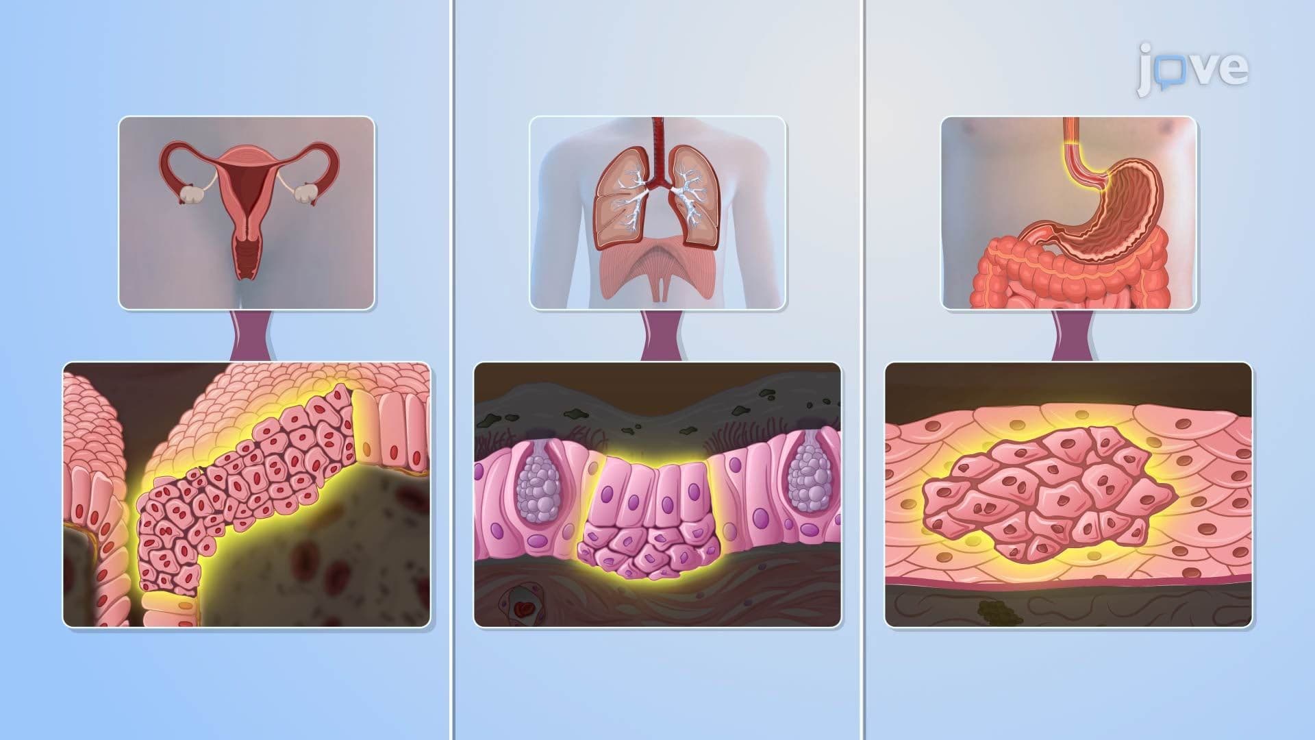 Cellular Adaptation IV: Dysplasia and Metaplasia