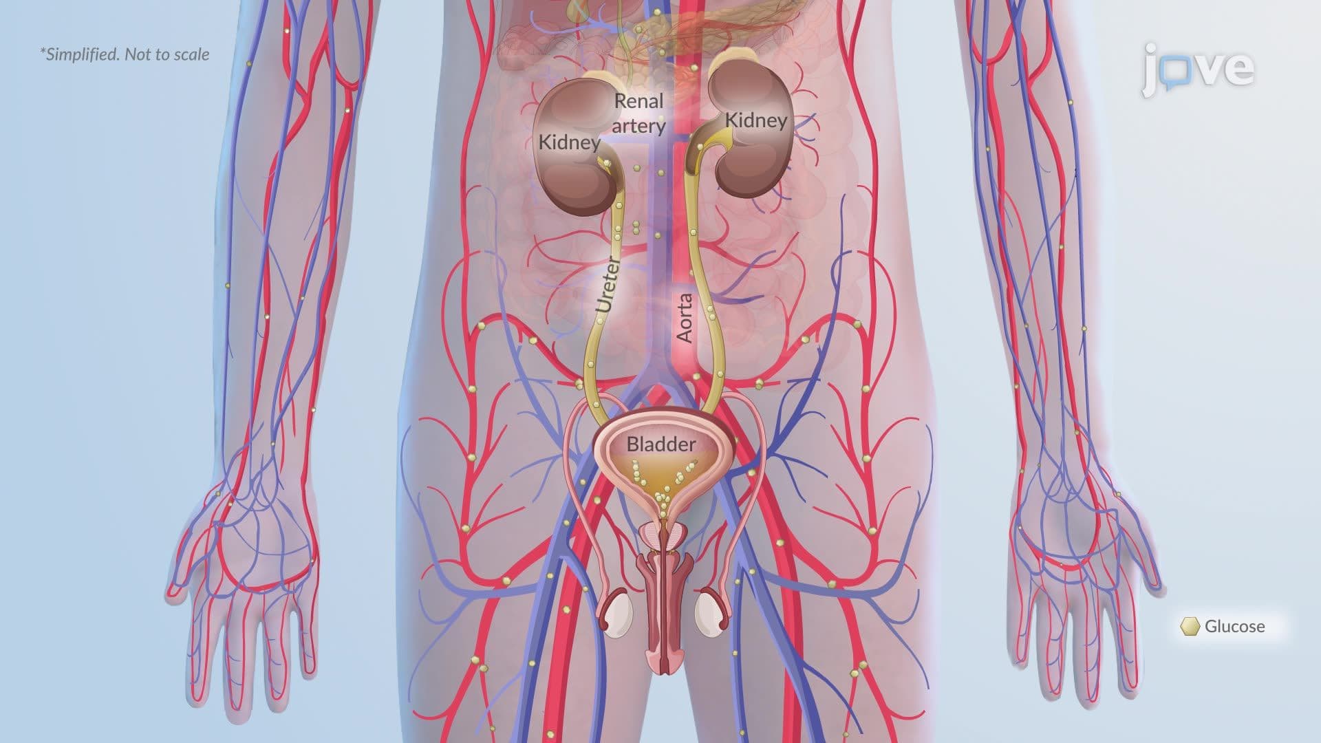 Diabetic Ketoacidosis ll: Pathophysiology
