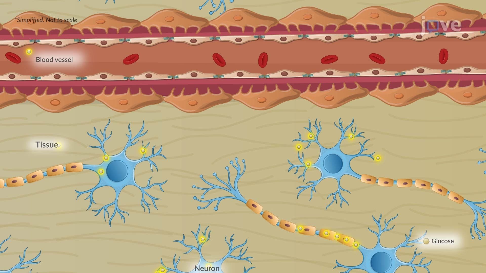 Diabetic Neuropathy