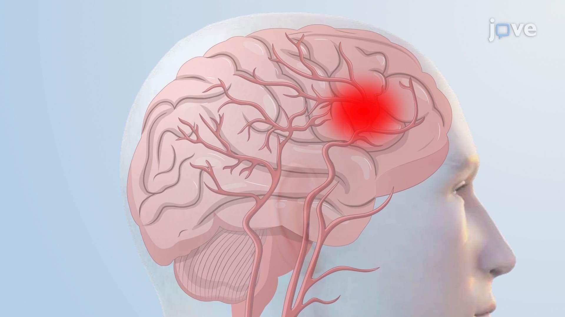 Stroke: Introduction and Types