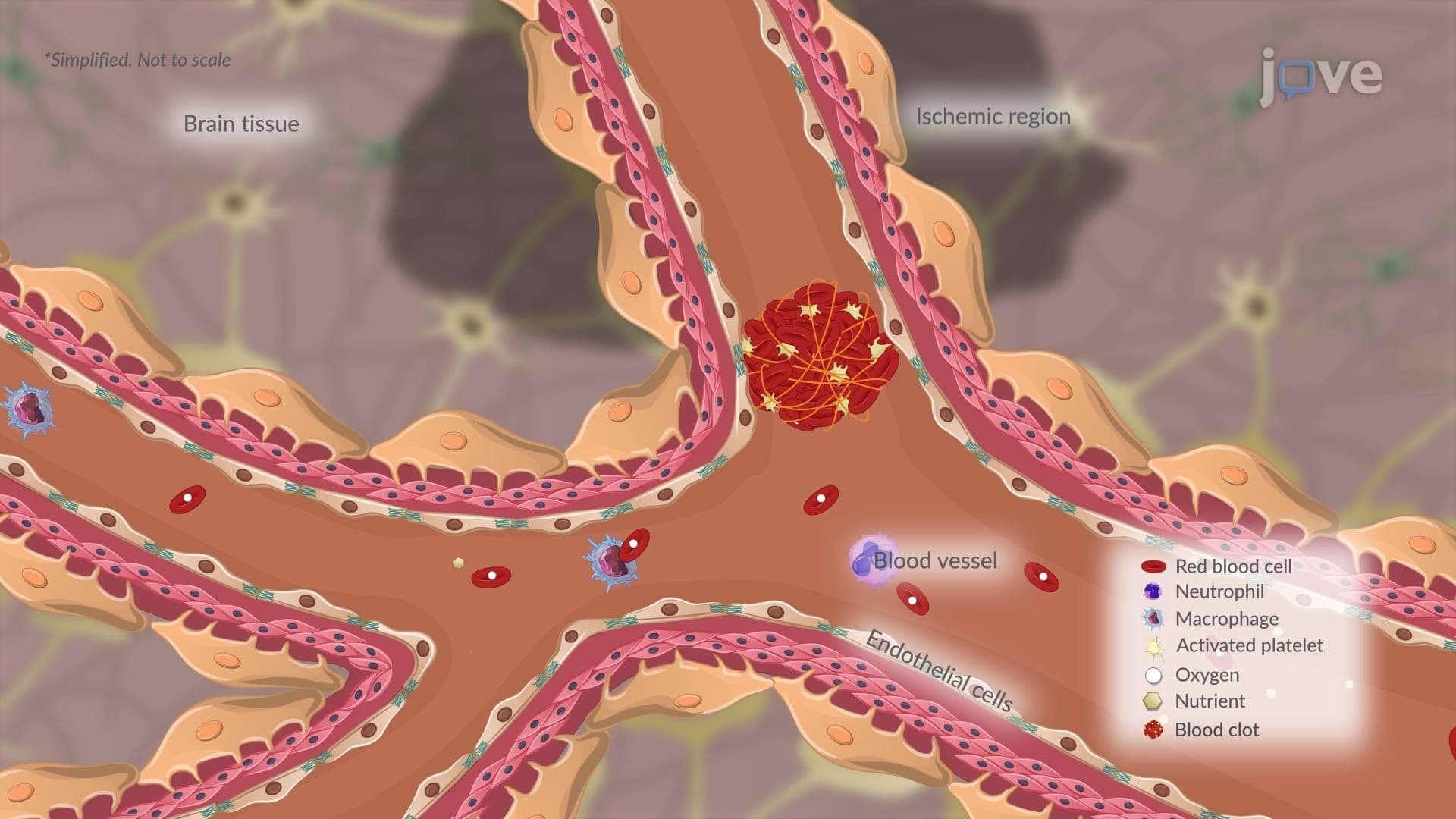 Transient Ischemic Attack l: Introduction