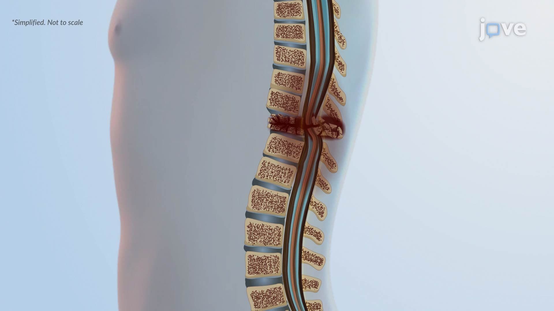 Spinal Cord Injury ll: Pathophysiology