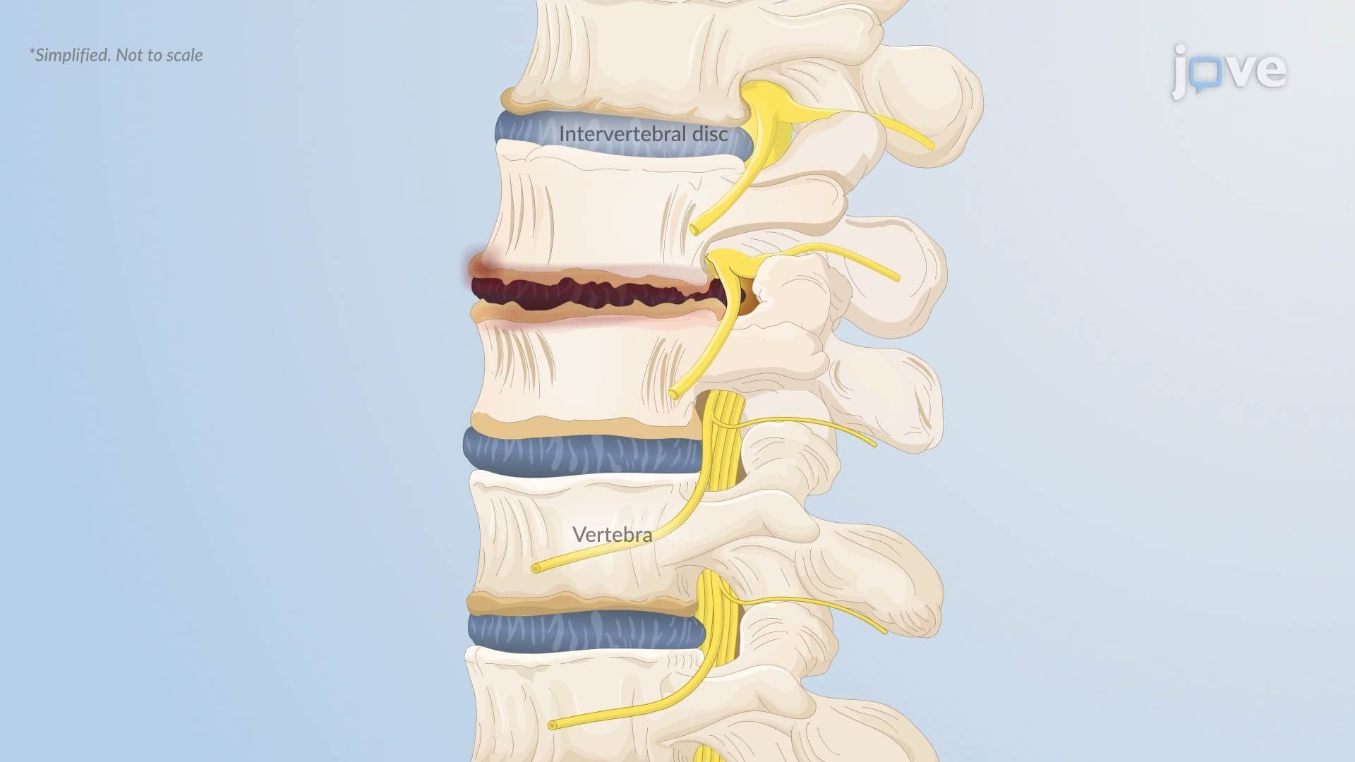 Herniated Intervertebral Disc l: Introduction