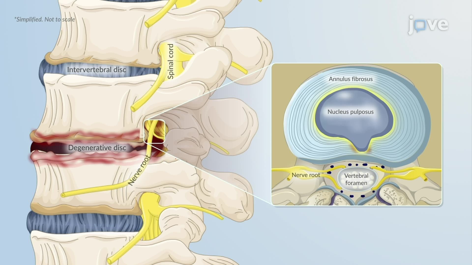 Degenerative Disc Disease ll: Pathophysiology