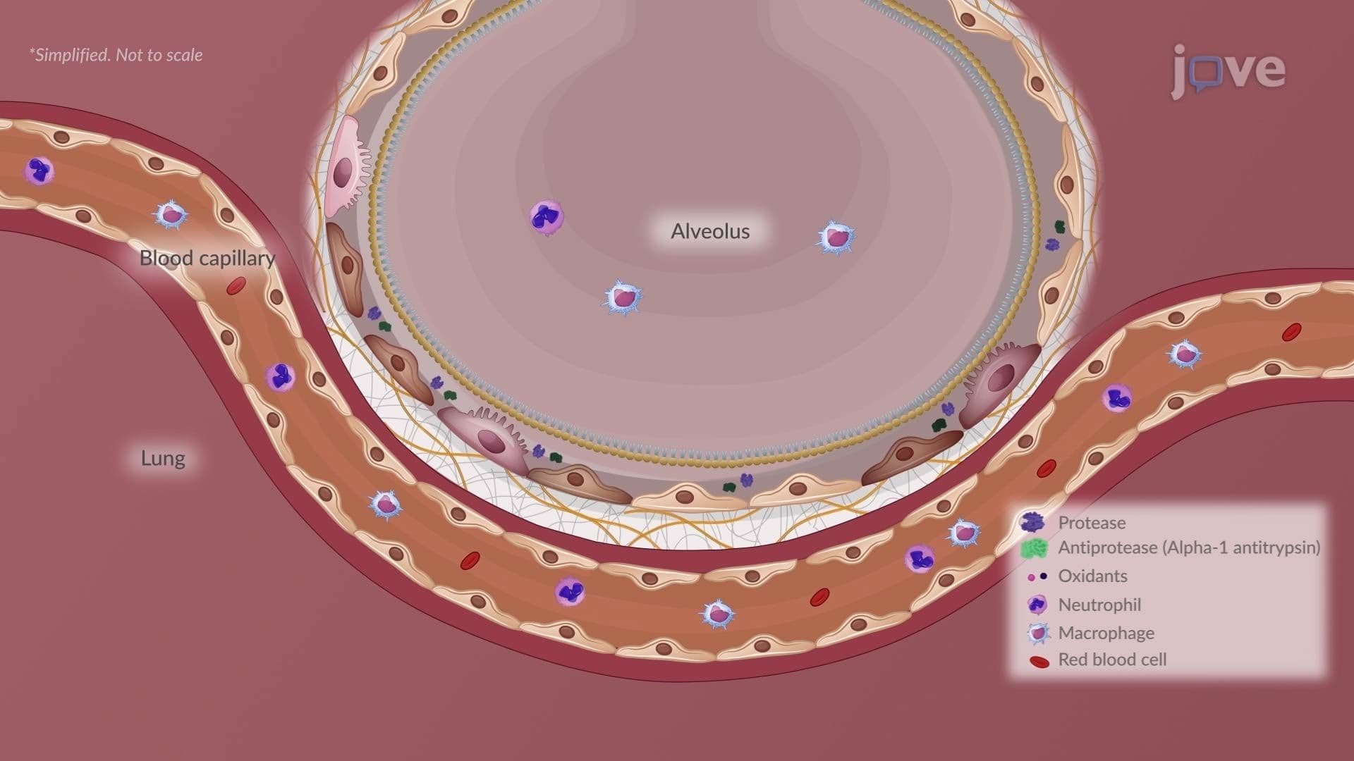Chronic Obstructive Pulmonary Disease II: Emphysema
