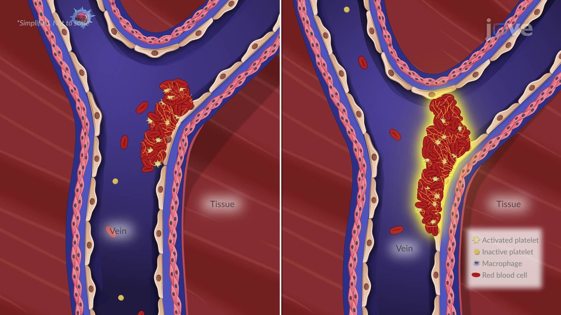 Pulmonary Embolism I: Introduction