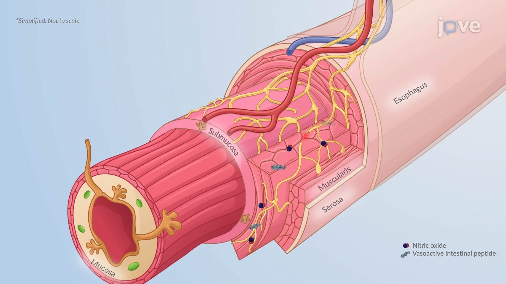 Esophageal Achalasia