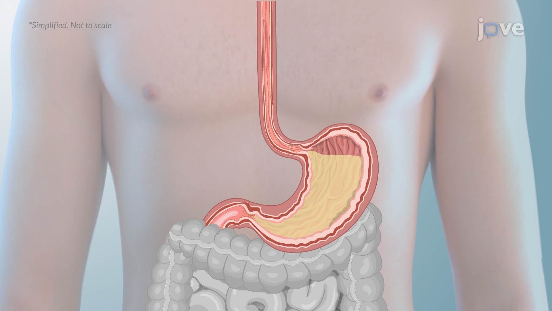 Gastroesophageal Reflux Disease