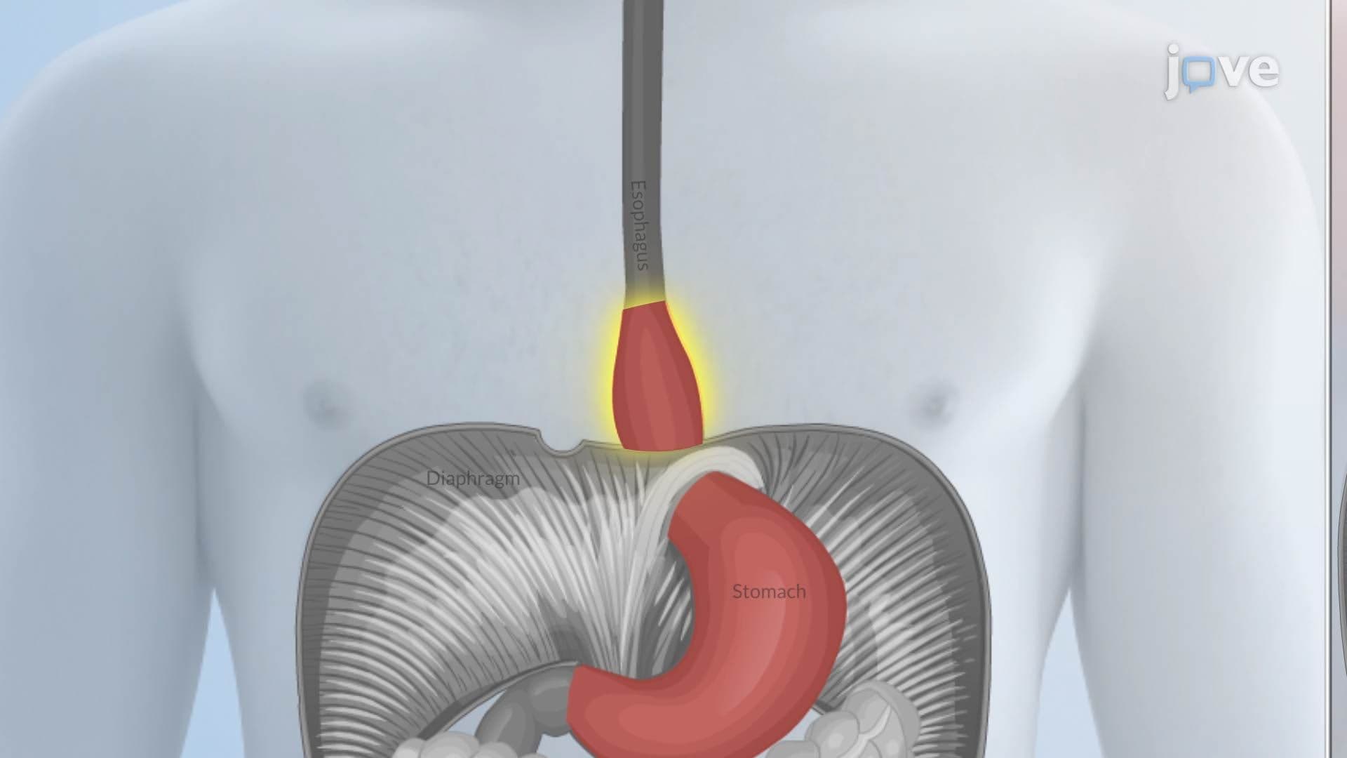 Hiatal Hernia