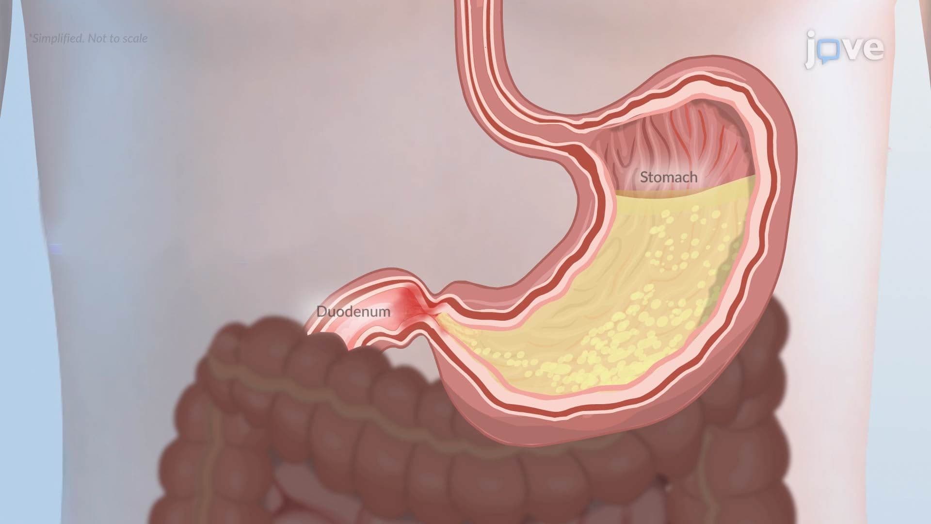 Pyloric Obstruction
