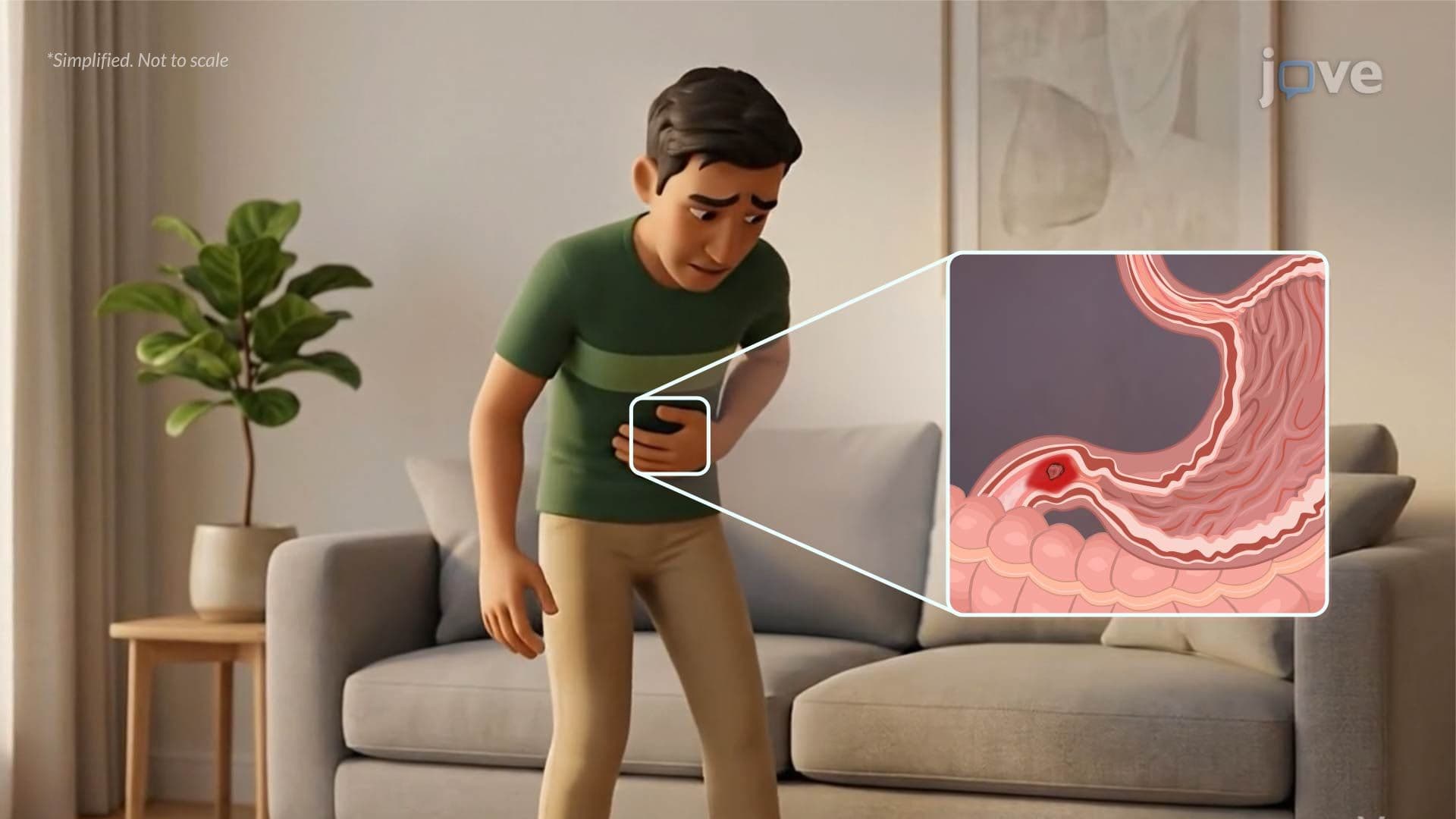 Peptic Ulcer Disease III: Clinical Manifestations and Complications