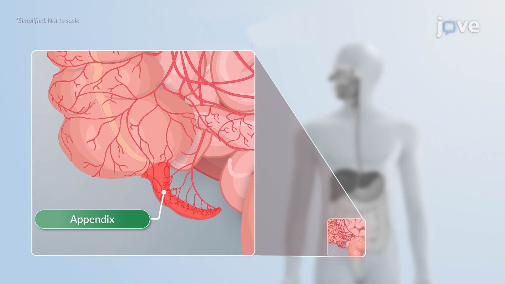 Appendicitis