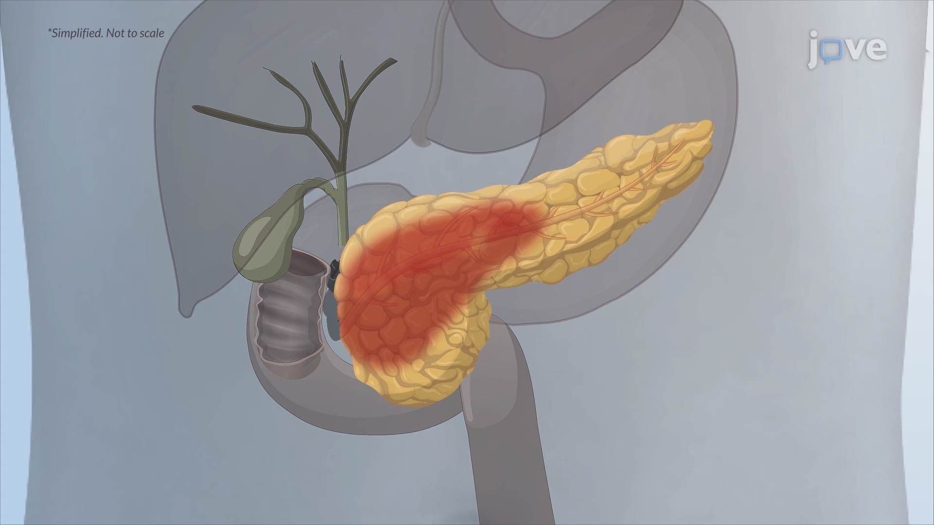 Chronic Pancreatitis I: Introduction