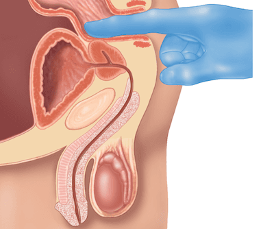 Male Rectal Exam