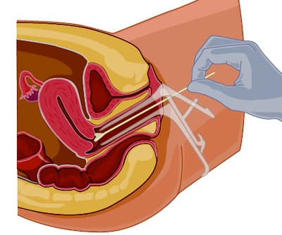 Pelvic Exam II: Speculum Exam