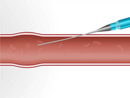 Arterial Line Placement