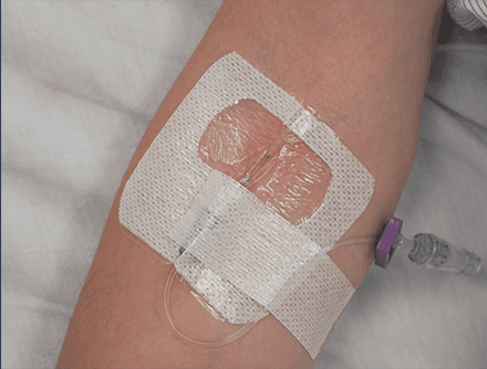 Peripheral Venous Cannulation