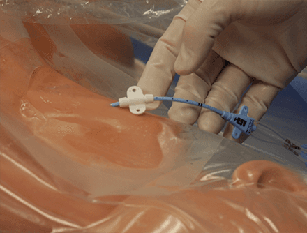 Central Venous Catheter Insertion: Internal Jugular