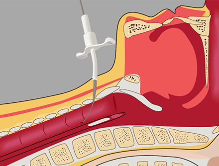 Percutaneous Cricothyrotomy