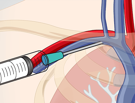 Central Venous Catheter Insertion: Subclavian Vein