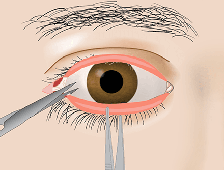 Lateral Canthotomy and Inferior Cantholysis