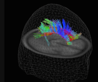 Using Diffusion Tensor Imaging in Traumatic Brain Injury