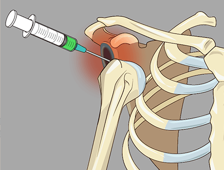 Intra-articular Shoulder Injection for Reduction Following Shoulder Dislocation