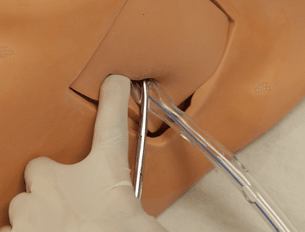 Tube Thoracostomy