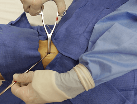 Open Cricothyrotomy